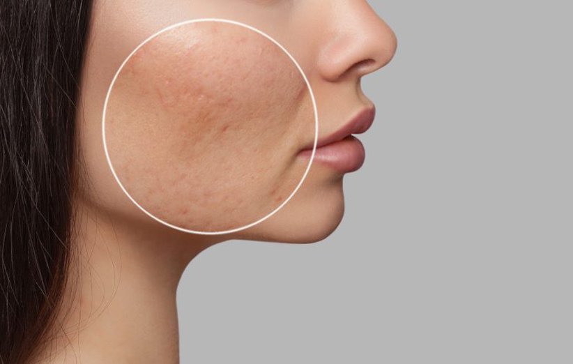 A few efficient methods for treating open pores on the skin.