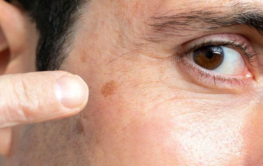 Several solutions to get rid of age-related skin spots